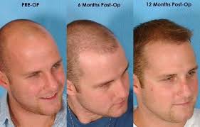 زراعة الشعر كيف تتم وما هي مخاطرها والفوائد زراعة الشعر في مصر عمليات زرع الشعر فى مصر واسعارها زرع Hair Transplant Best Hair Transplant Hair Transplant Women