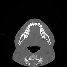 Image result for phlegmon on face)