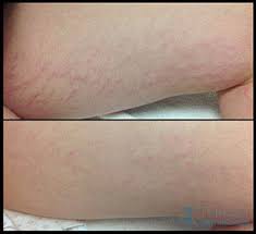 Stretcheal is a powerful stretch mark treatment cream and scars defense cream to make the appearance of red, white and purplish marks disappear. Stretch Mark Treatment Tareen Dermatology Roseville Minnesota