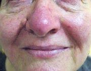 Andiamo a vedere nel dettaglio a quali alimenti deve fare attenzione chi è affetto da rosacea e se un'alimentazione sana può aiutare il trattamento. Acne Rosacea
