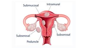 Acest tip de fibrom este considerat a fi responsabil de modificari ale menstruatiei, femeia sangerand abundent si mai multe zile. Fibromul Uterin Alpha Clinics