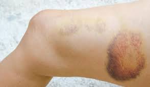 Hematomes Sans Coup Quelles Sont Les Causes Doctissimo