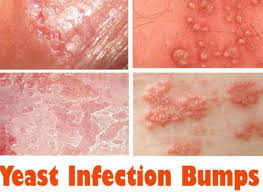 Some of the symptoms of a male yeast infection mimic those of sexually transmitted diseases, so it is important to consult your doctor to rule out a serious problem. Yeast Infections In Men Causes Symptoms Treatment Seasidehalfmarathon Com