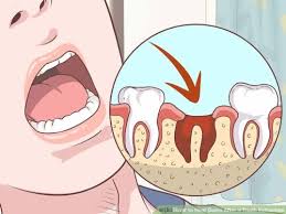 Image result for Tooth Extraction