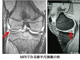 mriでみる膝半月損傷の例 半月板損傷 膝 半月