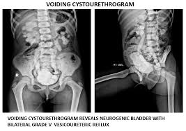 Image result for Voiding Cystourethrogram