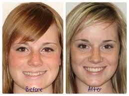 Why Are My Teeth Misaligned Wilkinson Orthodontic Pediatric Dentist Memphis Tn