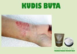 Ubat sapu mematikan hama dan menahan gatal adalah berlainan. Soleehaa Anggun Beauty Tips Menghilangkan Kudis Buta Dengan Cepat