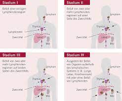 Hodgkin Und Non Hodgkin Lymphom Stadien Krebs De