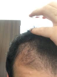 I had horrible side effects with both oral and topical finasteride. Dutasteride Finasteride Combine Succes Hairlosstalk Forums