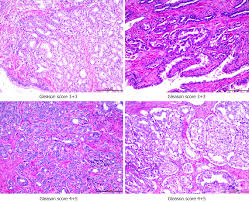 Feasibility Of Prostatectomy Without Prostate Biopsy In The