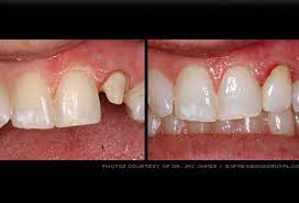 Maybe you would like to learn more about one of these? Dental Crown Picture Image On Medicinenet Com