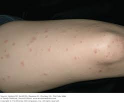 Image result for pruritic urticarial papules and plaques of pregnancy