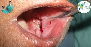 Image result for dental cancer