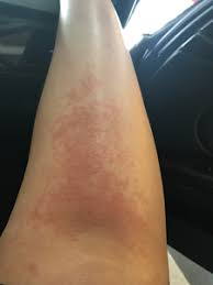 The condition is often characterized by intense itching around the affected area. Rash On Legs Hives June 2017 Babies Forums What To Expect