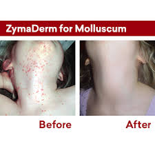 The bumps will go away on their own within months or one to two years.you can find information on how to cure molluscum contagiosum. Amazon Com Zymaderm Natural Molluscum Contagiosum Treatment For Kids Adults Fast Gentle Painless Plant Based Formulation Fda Registered Made In Usa 13 Milliliter Health Personal Care