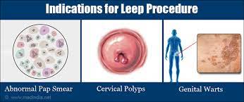 Leep Loop Electrosurgical Excision Procedure Indications Preparation Procedure Recovery Complications