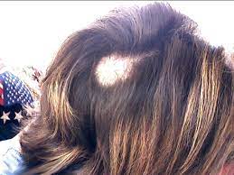 One is selenium, which is an element found in other ores. How Is Alcohol And Hair Loss Connected