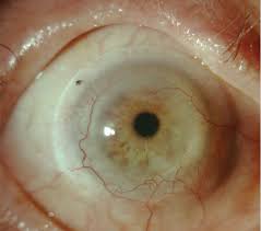 Image result for Cornea
