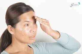 Da bị tăng sắc tố sau lăn kim, laser, peel da có trị được không?