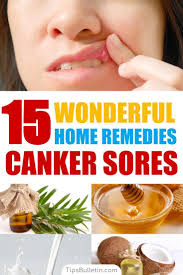 15 Canker Sore Relief Remedies That Work Canker Sore Remedy Canker Sore Canker Sore On Tongue