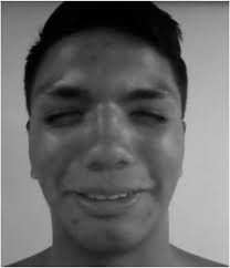 Urofacial (ochoa) syndrome: A literature review