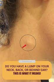 Vital Pieces Of Lumps On Neck Healthy Medicine Tips Skin Bumps Neck Healthy Skin Tips