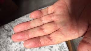 Many others are experiencing horrific co. Rashes Could Be Key Sign Of Covid 19 Here S What They Look Like Huffpost Uk Life