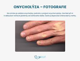Image result for Akutní zánět nehtového lůžka