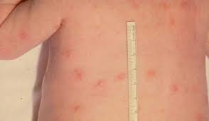 Maybe you would like to learn more about one of these? Ø§Ù„Ø­Ø²Ø§Ù… Ø§Ù„Ù†Ø§Ø±ÙŠ Ø¨Ø§Ù„ØµÙˆØ± Ù…Ø±Ø¶ Ø¬Ù„Ø¯Ù‰ Ø®Ø·ÙŠØ± Ø§ÙØ®Ù… ÙØ®Ù…Ù‡