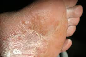 Untungnya, sebagian besar penyebab kaki gatal bisa. Cara Pengobatan Eksim Cara Mengobati Kulit Kering Bersisik Dan Gatal Pada Kaki