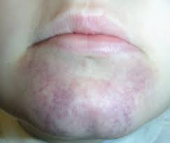 As the venous walls weaken, it forms an outpouching that is filled with venous blood or deoxygenated blood providing the spot its particular color. Factitious Purpura Consultant360