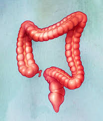 Image result for Diverticulitis