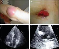 Image result for Cardiac Pacemaker Infection