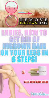 If not, smooth depilatory over this area and leave it on for a few more minutes. Ladies How To Get Rid Of Ingrown Hair On Your Legs In 6 Steps Ingrown Hair Ingrown Leg Hair Ingrown Hair Removal