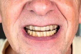 Image result for Tooth Discoloration