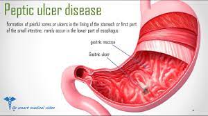 Quick Review Peptic Ulcer Disease Causes Treatment Youtube