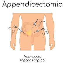 Peritonite causata dalla fuoriuscita del contenuto intestinale dall'appendice. Intervento Per Appendicite Preparazione E Procedura