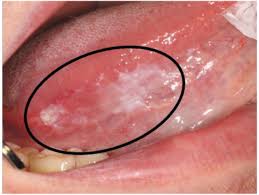 Image result for white cancer on tongue)