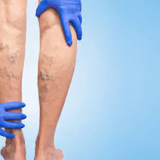 Trombosis — este artículo o sección necesita referencias que aparezcan en una publicación acreditada, como revistas especializadas, monografías, prensa diaria o páginas de internet fidedignas. Trombosis Revista Salud Y Cardiologia