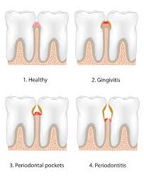 Image result for Gingivitis