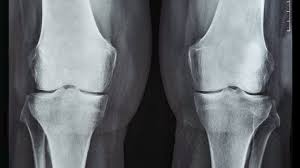 Image result for XRay Changes in Rheumatic Conditions