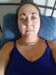 Woo y'all were right about the red face after the FHF chem peel 😂