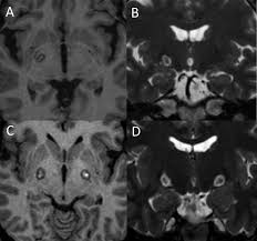 Image result for Pallidotomy