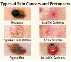 There are 3 main types of skin cancer: Skin Cancer Codifyre