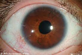 Marfan Syndrome Eyerounds Org Ophthalmology The University Of Iowa