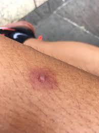 Hey Reddit! My little bro got this bug bite here. Can we pop this or should  we wait? : rpopping