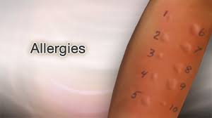 Allergy shots don't cure allergies, but they stimulate the immune system. Allergy Shots Information Mount Sinai New York