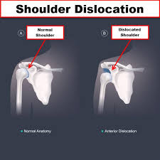 Image result for Fall on Shoulder