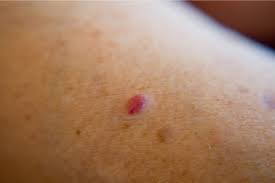 Image result for Merkel Cell Carcinoma